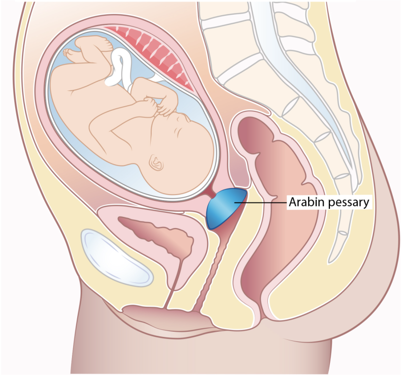 đặt vòng nâng arabin trong doạ sinh non