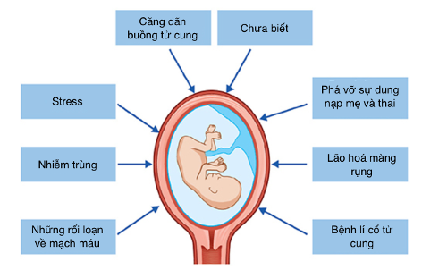 Những cơ chế sinh non tự phát được đề xuất