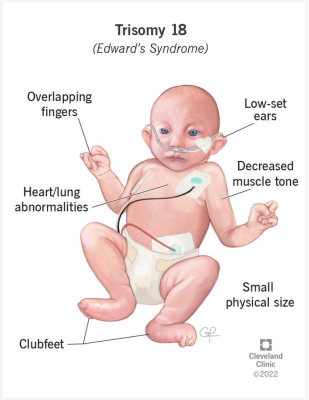 Hội chứng Edwards gây ảnh hưởng đa cơ quan. Một số đặc trưng có thể kể như ngón tay co quặp, lỗ tai đóng thấp, giảm trương lực cơ, bàn chân khoèo, bất thường tim, phổi