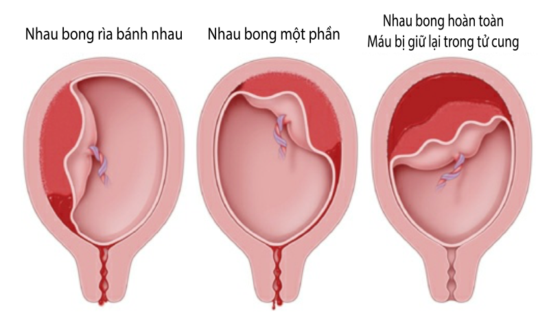 Các loại nhau bong non