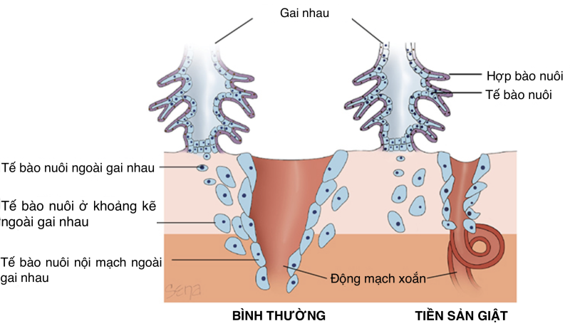 Hình 1. Sự tái tạo các động mạch xoắn của các tế bào nuôi trong thai kì bình thường (trái) và thai kì tiền sản giật (phải). Nguồn: William Obstetrics 26e