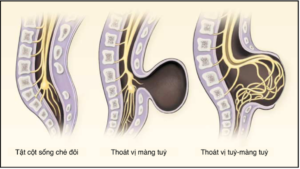 CÁC DẠNG DỊ TẬT ỐNG THẦN KINH