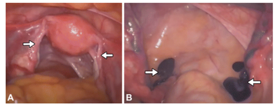Hình ảnh tử cung và ống dẫn trứng bình thường trong phẫu thuật nội soi